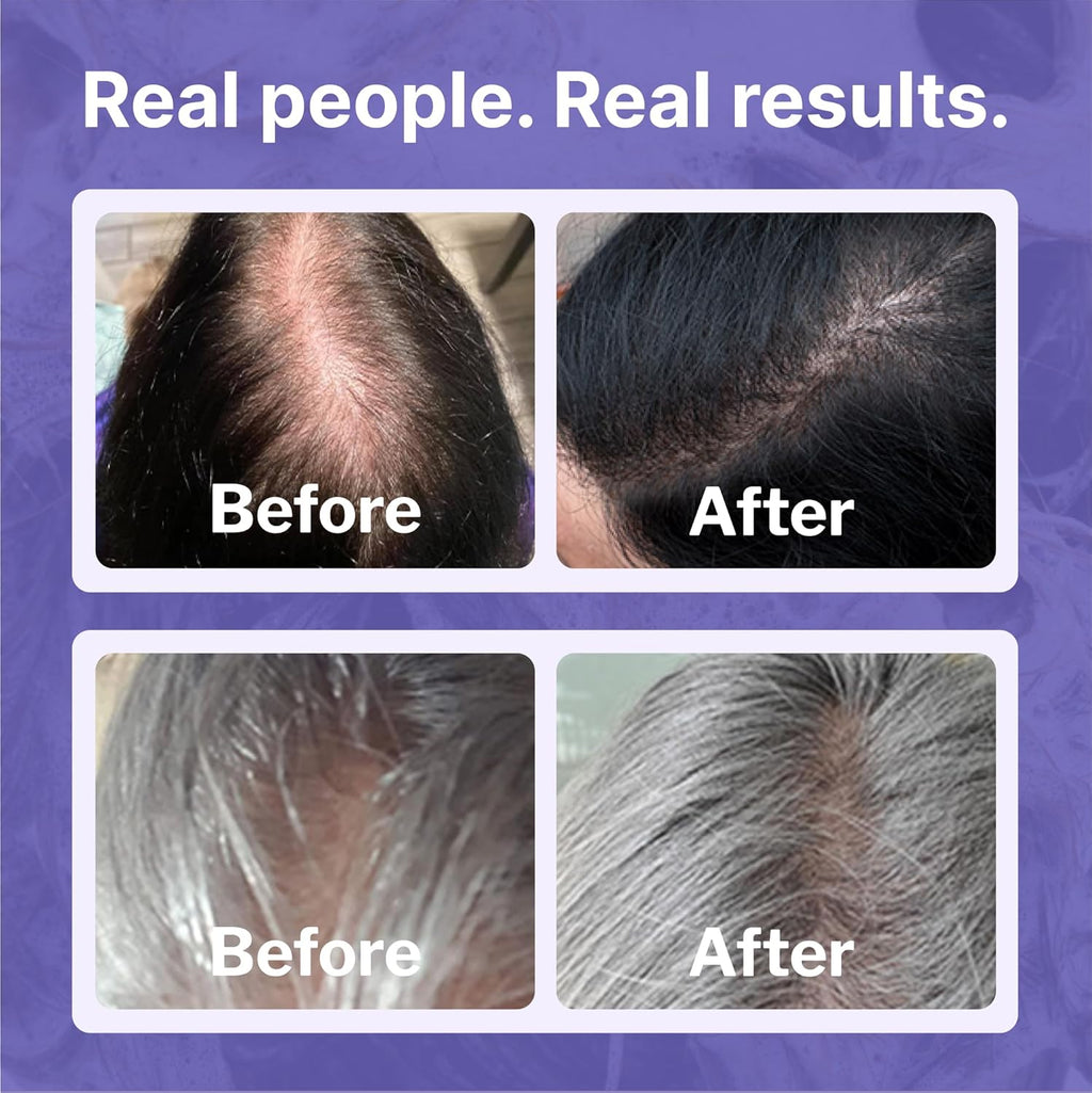 Women's Regrowth Kit: Shampoo, Conditioner, 2% Minoxidil, Leave-In Foamer A91658